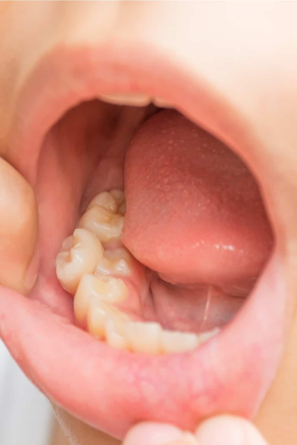 Can You Drink Coffee After Tooth Extraction?